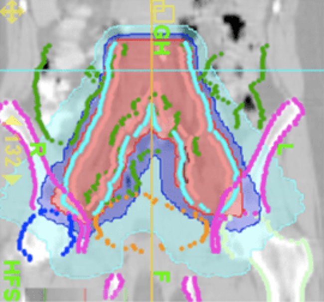 Radiobiología. Diagnóstico e tratamento de  neoplasias xinecolóxicas